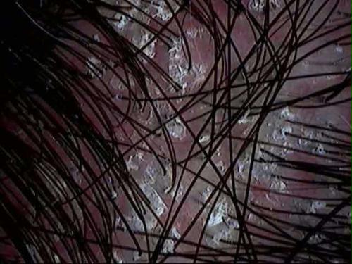 Iperseborrea - PROBLEMI CUOIO CAPELLUTO - Area scientifica ...