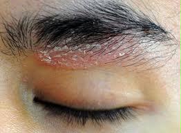 Dermatite seborroica - PROBLEMI CUOIO CAPELLUTO - Area ...