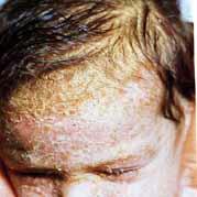 Dermatite Seborroica Problemi Cuoio Capelluto Area Scientifica Cesare Ragazzi Laboratories
