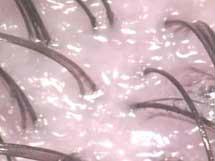 Iperidrosi - PROBLEMI CUOIO CAPELLUTO - Area scientifica ...